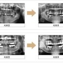 임플란트 이것이 궁금하다!! 이미지