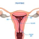 자궁내막 용종 생리가 아닌데요 피가 나온다면 이미지