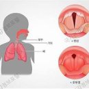 후두염 원인과 증상 역류성후두염 예방법은 이미지