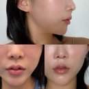 청담동 실루엣소프트 실리프팅 가격 안아까운 일주일차 솔직 후기 내돈내산