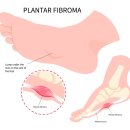 부천중동위드본정형외과의원 | 중동 정형외과, 족저근막염 원인은?