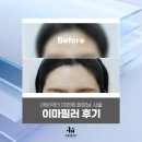 JY피부과 | 압구정 피부과 이마필러 후기 및 케이스 분석(아트닥터 이현정 원장님 진행)