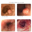 대장암의 위험성이 있는 대장 질환 (선종성 용종/가족성 용종증/크론병/궤양성 대장염) 이미지