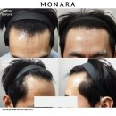 m자 모발이식 수술 리얼 후기와 모발이식 비용은