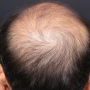 상일초등학교 | 강동구탈모병원, 리제네라액티바 탈모치료 7개월차 실제 경과 후기