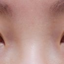 청담청초성형외과의원 | 근육고정 앞트임 수술- 청담청초 성형외과