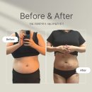 후케어 | 천호 복부 지방제거주사 시술 후 2주차 후기 +오렌지케어 후관리까지 완벽!