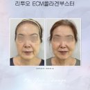 오피부과의원 | [청담포레브] 피부과 원장님도 받는 그 콜라겐부스터, K피부과열풍 엘라비에 리투오후기