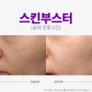 진스킨피부과 네이버블로그