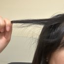 멍멍헤어 | 여자 헤어라인 모발이식 비절개 재수술 후기 500+모