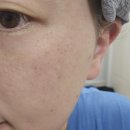 (주)우신라보타치 | 여름 대비한 잡티 고민 &#39;라보타치 기미 패치&#39; 후기