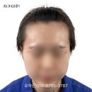 라인 | 강남 헤어라인 전문 모하린, 실패없는 자연스러운 헤어라인 후기