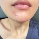 본초당약국 | 이소페린, 퀘르센 고함량으로 턱 여드름·좁쌀 여드름에 효과 본 후기! (피부과 공동 개발)