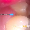송정아가페치과의원 | 수면 매복 사랑니 한 번에 발치 송정역 치과 서울쏙쏙치과