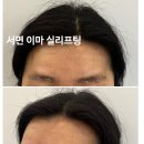 달뜰목 | 부산이마 실리프팅 한달 솔직후기 | 멍O,부작용, 붓기, 효과