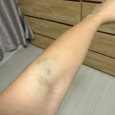 한일가스 산소 | [난저 임신준비]자궁경 후기