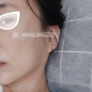 부산행복이비인후과의원 | 부산 침샘보톡스 [3편] 침샘염 진단 후 항생제 5일 복용, 붓기 변화