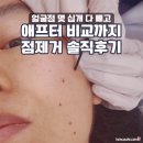 굿포유피부과의원 | 홍대입구역 피부과 점제거 | 얼굴 점, 잡티 한 번에 끝낸 솔직 리얼 후기
