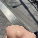 경희한의원 | 결절종 제거 후기│ 금천구 시흥동 <경희태평한의원>