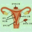 자궁근종이 생기는 이유? 이미지