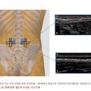 Re: frozen back 흉요건막 두꺼워짐!! 초음파 진단 이미지