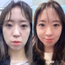 볼륨 | 강남피부과 쥬베룩볼륨 후기