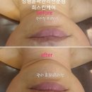 희스킨