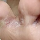 부땅골 | 땅고 리얼큐어 문제성발톱 완치루틴 총정리