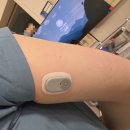 한독병원 | [한독] 바로잰 연속혈당 측정기 첫 사용기 (당뇨환자X)