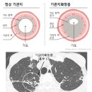 기관지확장증 (서울대학교병원ㆍ2022) 이미지