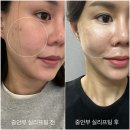 미래 소프트 | 중안부 실리프팅 종류 실루엣소프트 유지기간 종류 통증 기간 후기 방출해요.