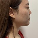 에스본한의원 | [안산/화성] 에스본한의원에서 코매선(화이트코) 시술받은 후기