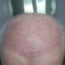 fine thanks | Korean after turkey hair transplant month