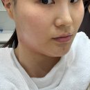 갤러리성형외과의원 | [신사피부과추천] 리브성형외과 인모드로 안면윤곽 수술효과를?
