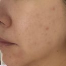 소라한의원 | 디마프 만능기초 판테놀 앰플 내돈내산 성인여드름 피부장벽 2개월 사용 후기