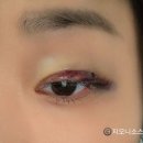 삼일약국 | 대망의 쌍수 1일~3일차 후기(돌출안 무쌍의 수술 후기)