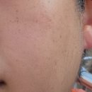 내돈내산) 진아름다운피부과의원 주근깨 제거 후기
