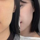 김나영 - 중구 우정혁신도시 | 일산피부과 볼뉴머 600샷 김나영 리프팅 솔직 후기