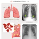 기침의 경고 - 노년층의 폐질환/EBS 방송 명의자료 2 이미지