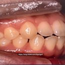 채움교정치과기공소 | 30대 치과위생사의 내돈내산 치아 교정 리얼 후기 (앞니 부분 교정/클리피씨/MTA 교정 기간)