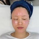 디엘르 에스테틱 | 부산 슈퍼젝션 블루 솔직후기(효과, 통증) | 얼굴 볼륨감을 살리고 싶을때 슈퍼젝션...