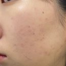 비비한의원 | [내돈내산] 서울 홍대 한의원 새살침 여드름 흉터 치료 2회차 후기