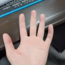 이석열 | [다한증] 손 다한증 수술 후기(2023년 5월 수술) _1편