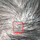 박종태유바외과의원 | 박종태유바외과, 두피 피지낭종 수술 후기