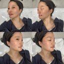 강남 | 강남 온다리프팅 후기 및 날짜별 경과 (통증,가격,시술효과)