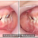 부산예스치과의원 네이버블로그