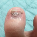 레푸스 범어점 | 자힝이 발톱교정 후기 -☆ 내성발톱 교정 (feat.대구 레푸스범어점) 1일경과