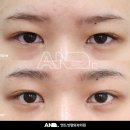 앤드성형외과의원 | 이마리프팅 내시경 이마거상 유지기간과 비용비교: 눈썹리프팅 효과까지 (20대 후기)