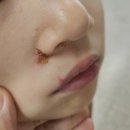 이앤장피부과 네이버블로그