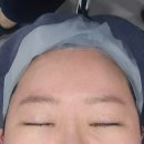 크로스리프팅 | 수원실리프팅 또렷한 눈매 실리프팅 변화 후기